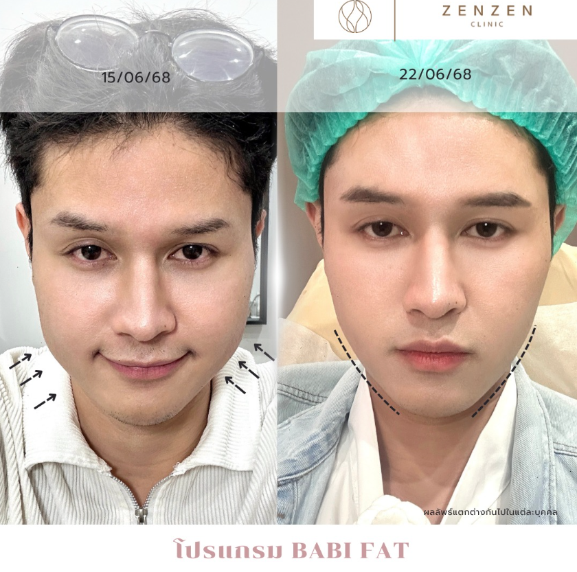 Zenzen Clinic before and after 5