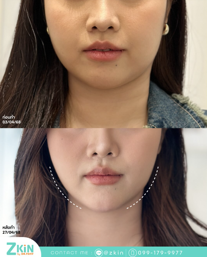 Zkin by Doctor Tony 10